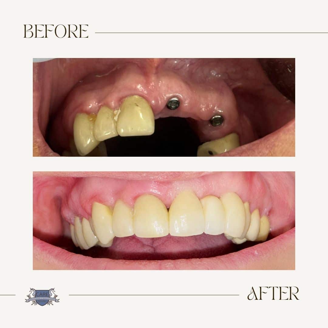 Care Dental before and after result 1