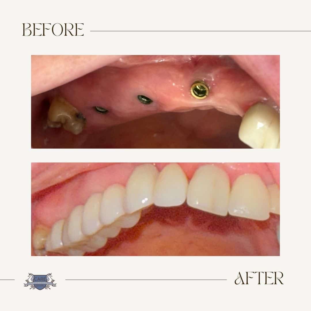 Care Dental before and after result 2