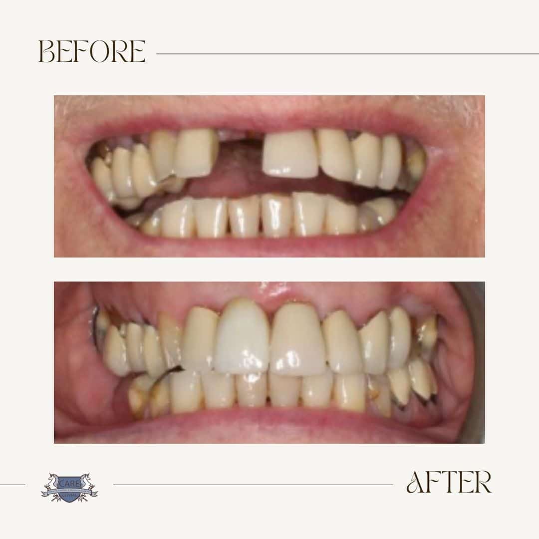 Care Dental before and after result 3