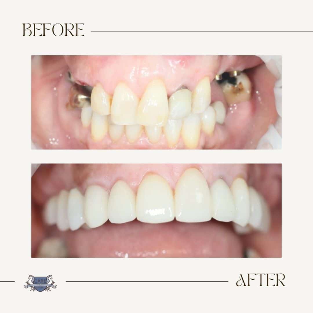 Care Dental before and after result 5